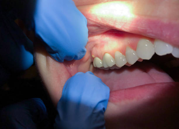 Best Emergency Gum Pain Relief  in Avilla, IN